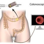 COLONOSCOPY image